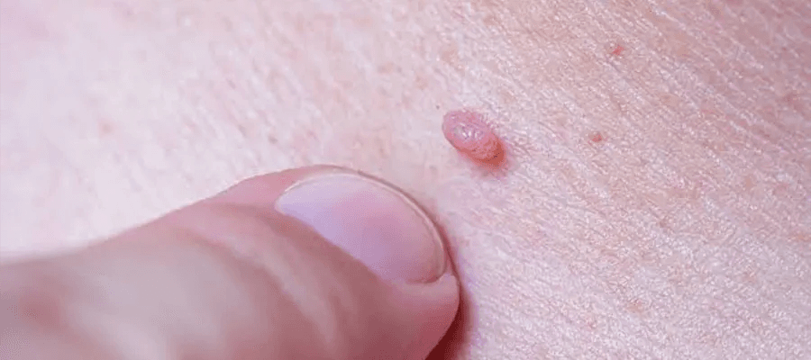 HPV & Genital Siğil Tedavisi