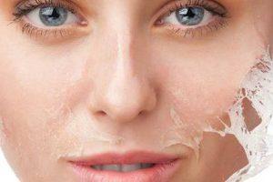 Kimyasal Peeling