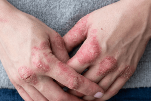 Sedef Hastalığı (Psoriasis)